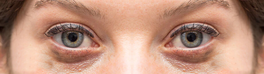 Темные круги под глазами – причины и лечение синяков под глазами
