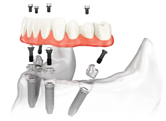 Протезирование на 4 имплантах в Дербенте