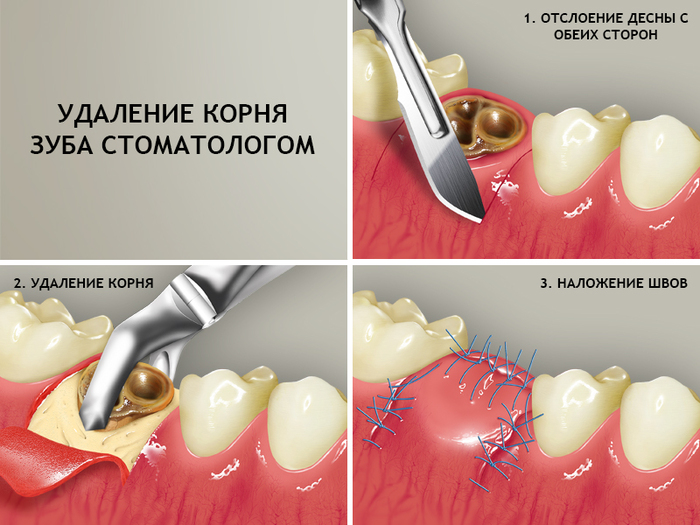 удаление зуба Томск Казахский