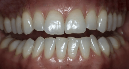 Как выглядят зубы перед отбеливанием в клинике Пробел на Ленинградском проспекте