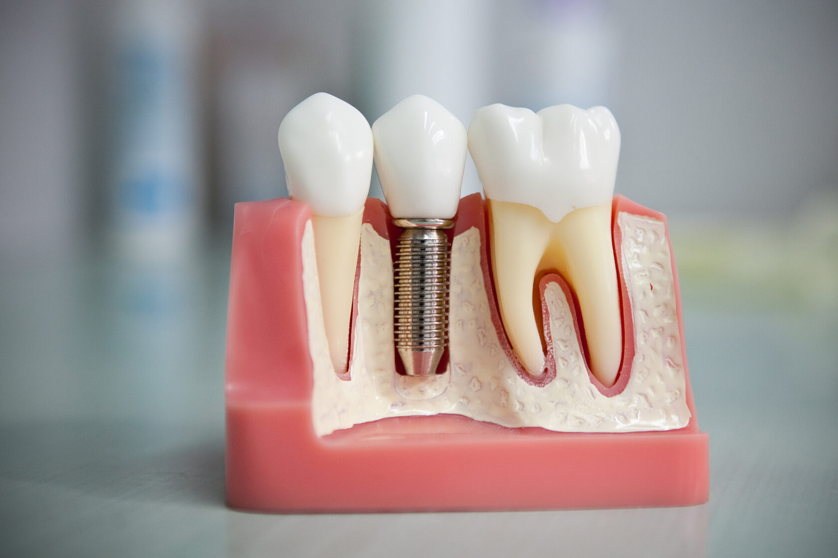 Как исключить риск отторжение зубного импланта плазмолифтинг