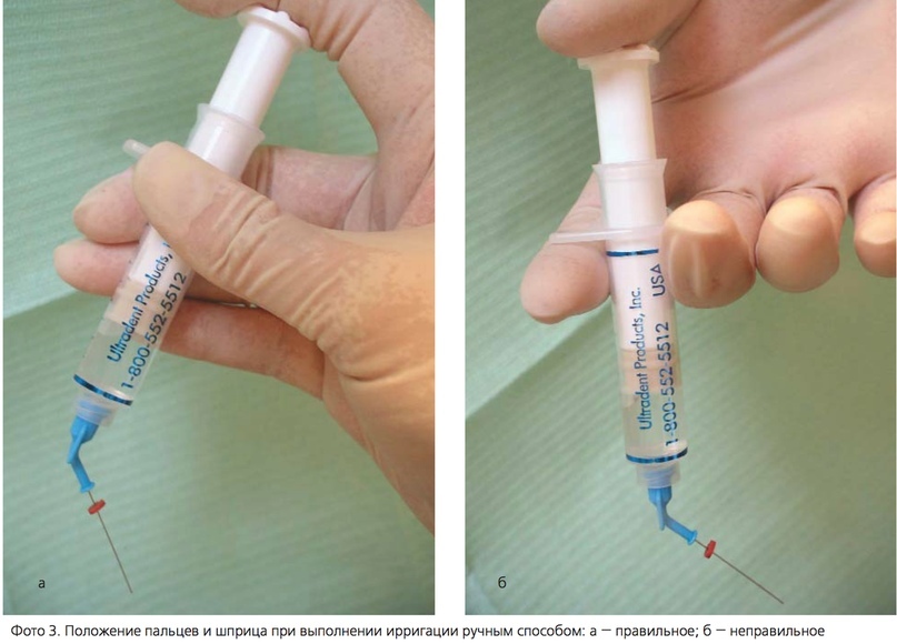 Чем промывают каналы. Эндодонтическая игла для ирригации корневых каналов. Ультразвуковая ирригация корневых каналов. Шприцы для ирригации корневых каналов. Метод ирригации корневых каналов.