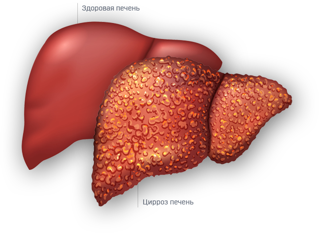 Цирроз пью. Постгепатический цирроз печени. Цирроз печени заболевания печени. Цирроз печени анатомия. Стеатоз печени цирроз и гепатит.