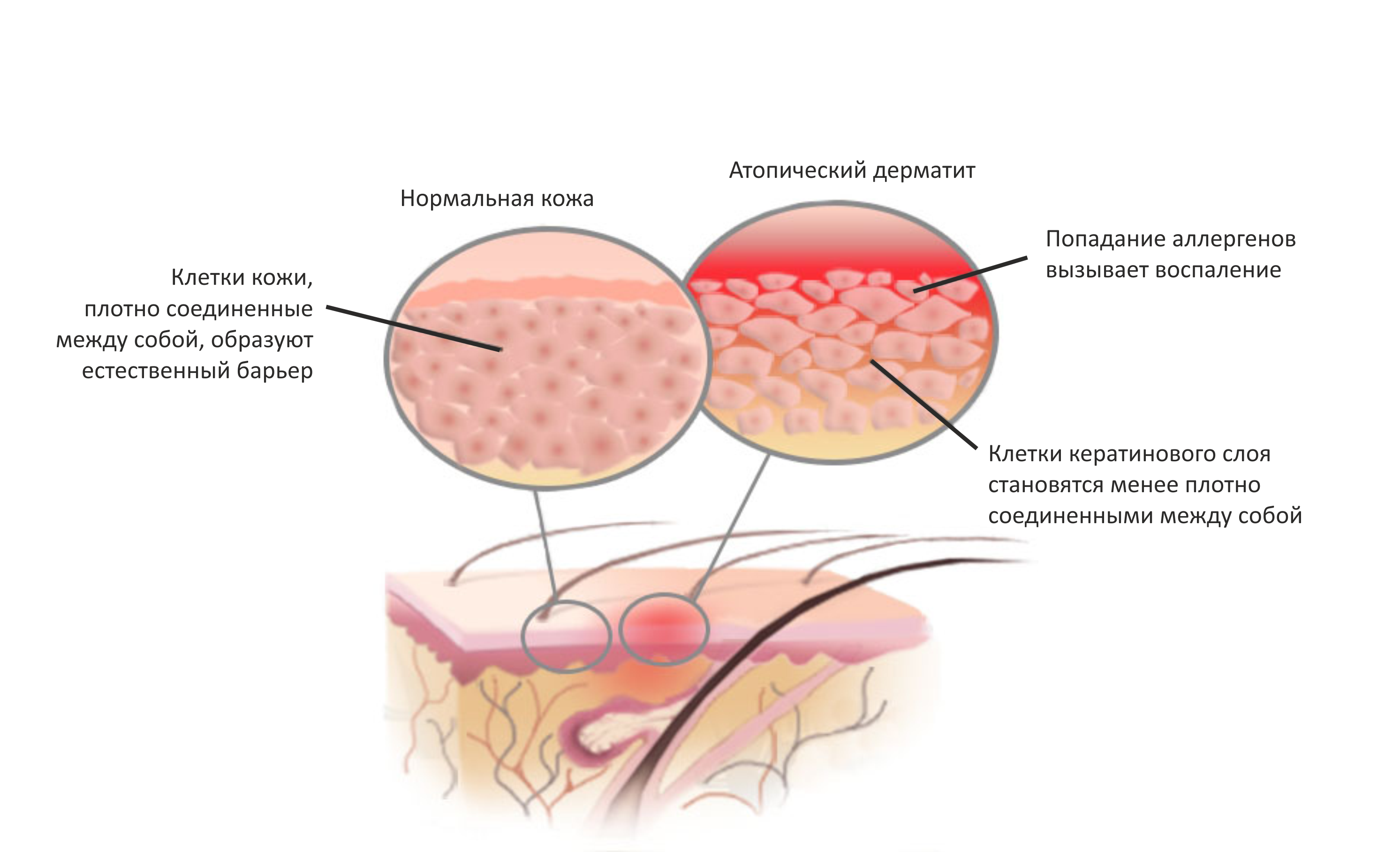 Этиология сыпей. Лихеноидная форма атопического дерматита. Атопический аллергический дерматит у взрослых. Атопический дерматит (нейродермит). Высыпания атопического дерматита.
