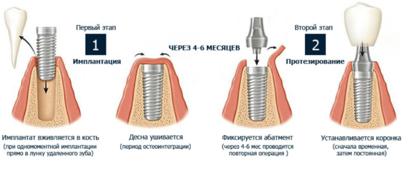 Как вживляют имплант. Протокол двухэтапной имплантации. Этапы стоматологической имплантации. Схема установки стоматологических имплантов.