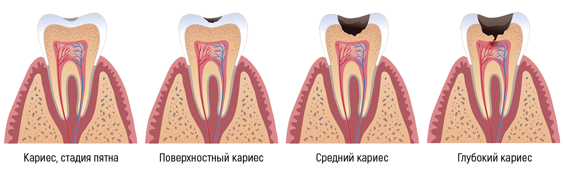 Этапы лечения кариеса цемента