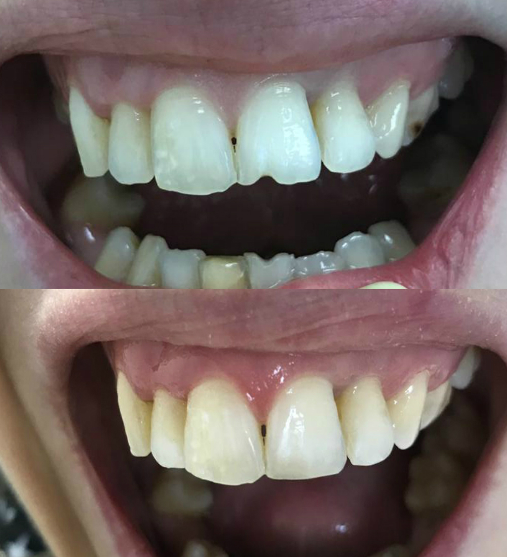 реставрация зубов в дрожжино результат
