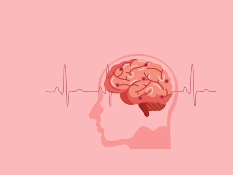 Микроинсульт: первые признаки и симптомы, лечение и последствия