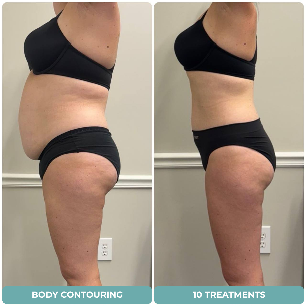 Body Contouring EndoLuxx at Beauty Studio by Hanna