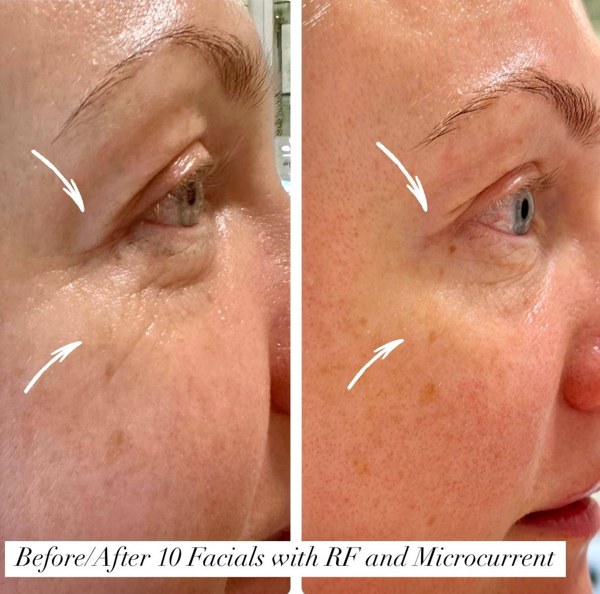 RF Microcurrent before and after fine lines jawline Beauty Studio by Hanna Mount Pleasant SC