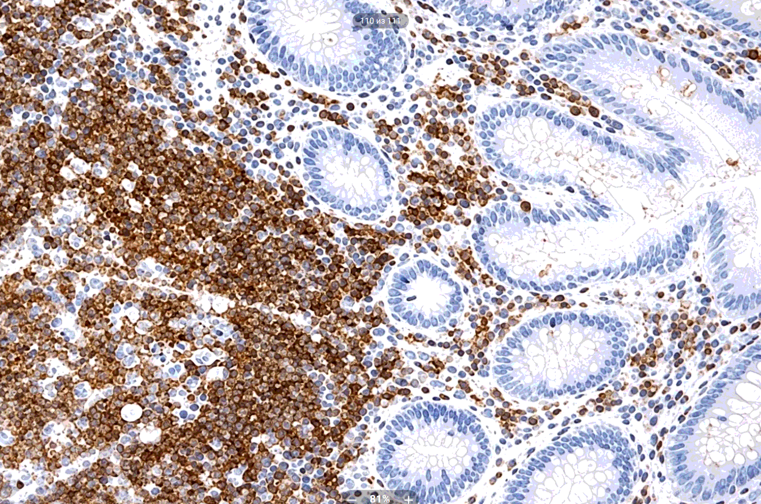 Недостаточное окрашивание CD45 в аппендиксе