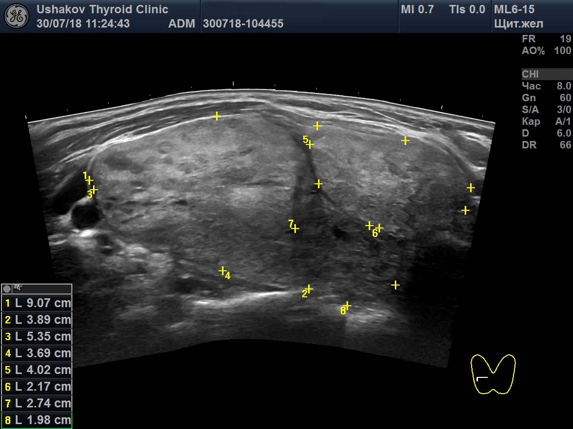 Узи нижних конечностей изранов. УЗИ щитовидной железы Изранов. УЗИ щитовидной железы протокол Изранов. УЗИ протокол щит жел. УЗИ Изранов протоколы.