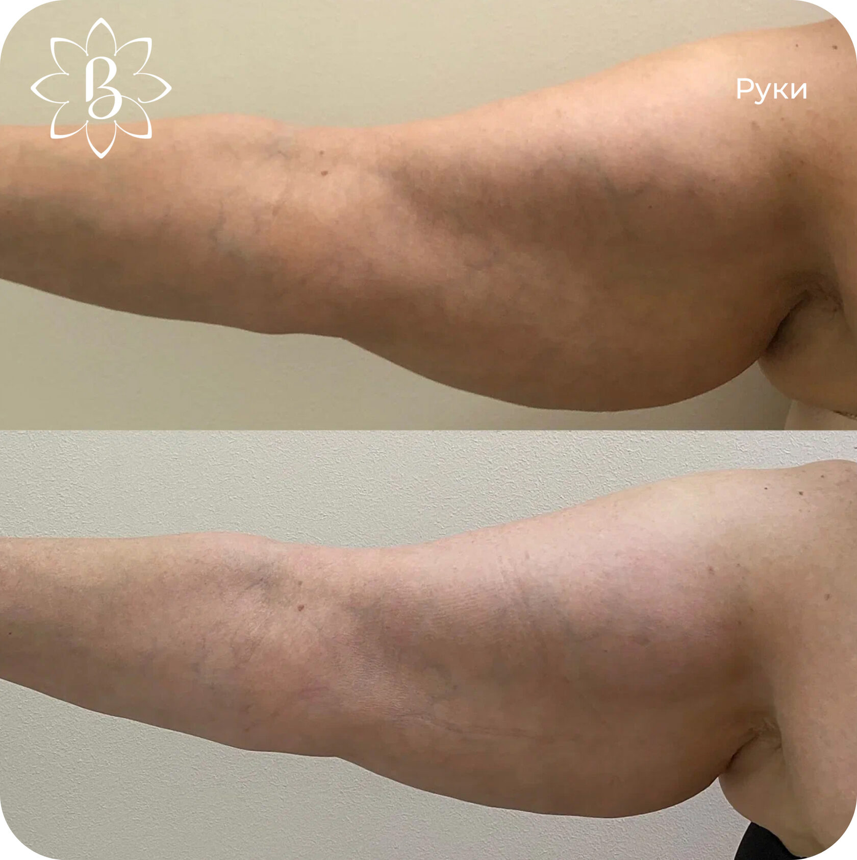 Диодная лазерная эпиляция СПб