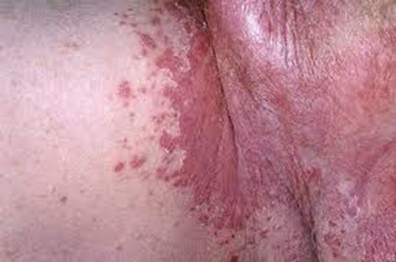 Причины возникновения аллергического васкулита кожи.