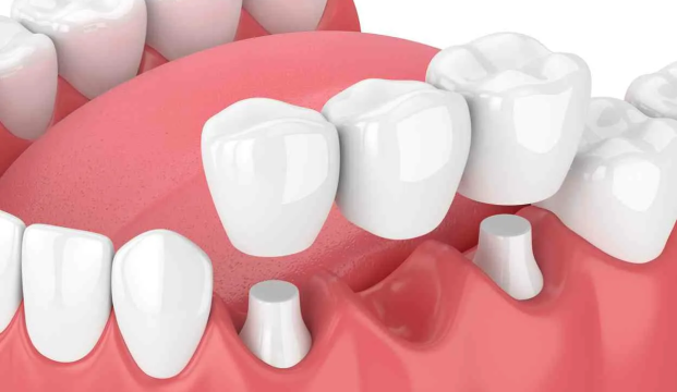 Виды зубных мостов – как выбрать оптимальный протез