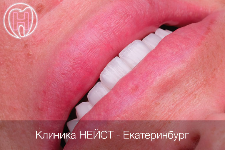 Премиальные керамические виниры в Екатеринбурге цвет Блич 2 (Bleach 2)