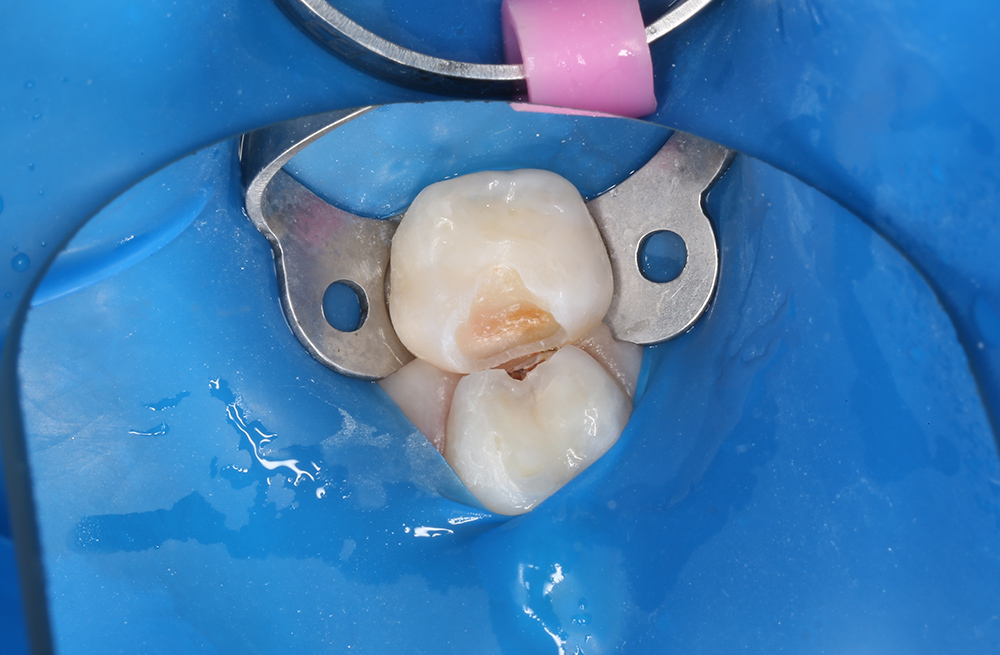 Композитное восстановление 55 зуба при кариесе у ребенка