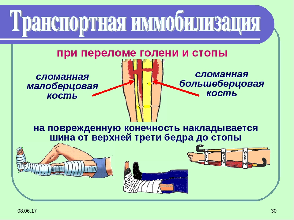 Шина на конечность. Транспортная иммобилизация при переломе голени. Перелом костей стопы транспортная иммобилизация. Транспортная шина при переломе голени алгоритм. Иммобилизацию транспортными шинами при переломе костей голени..