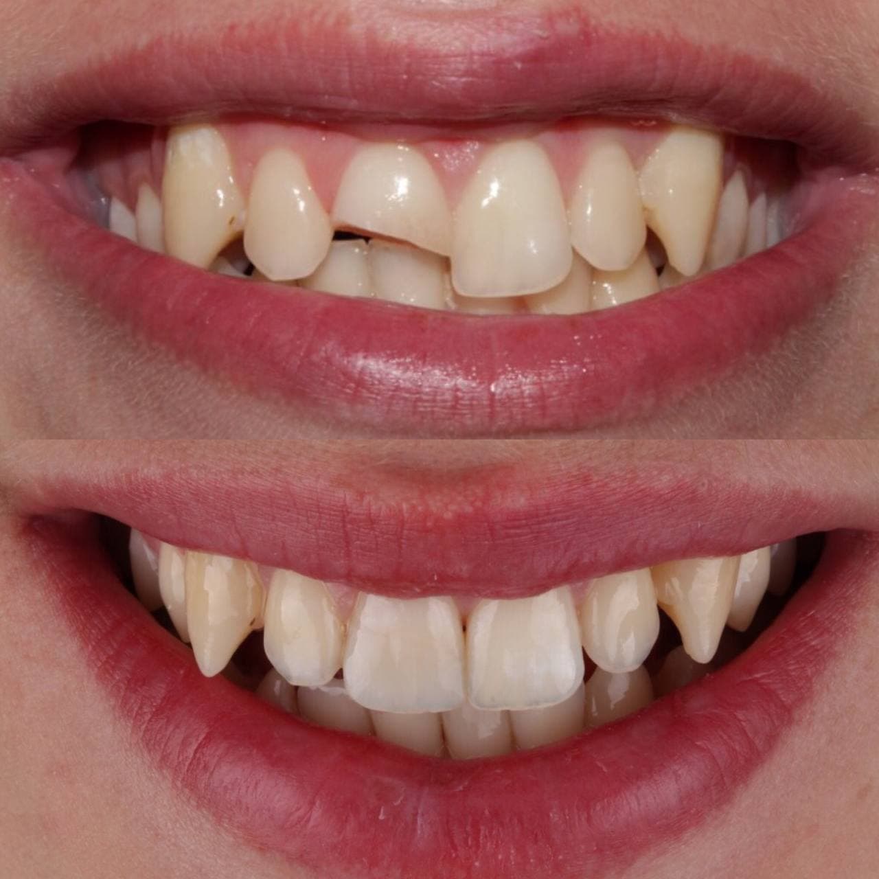 Фронтальная группа зубов