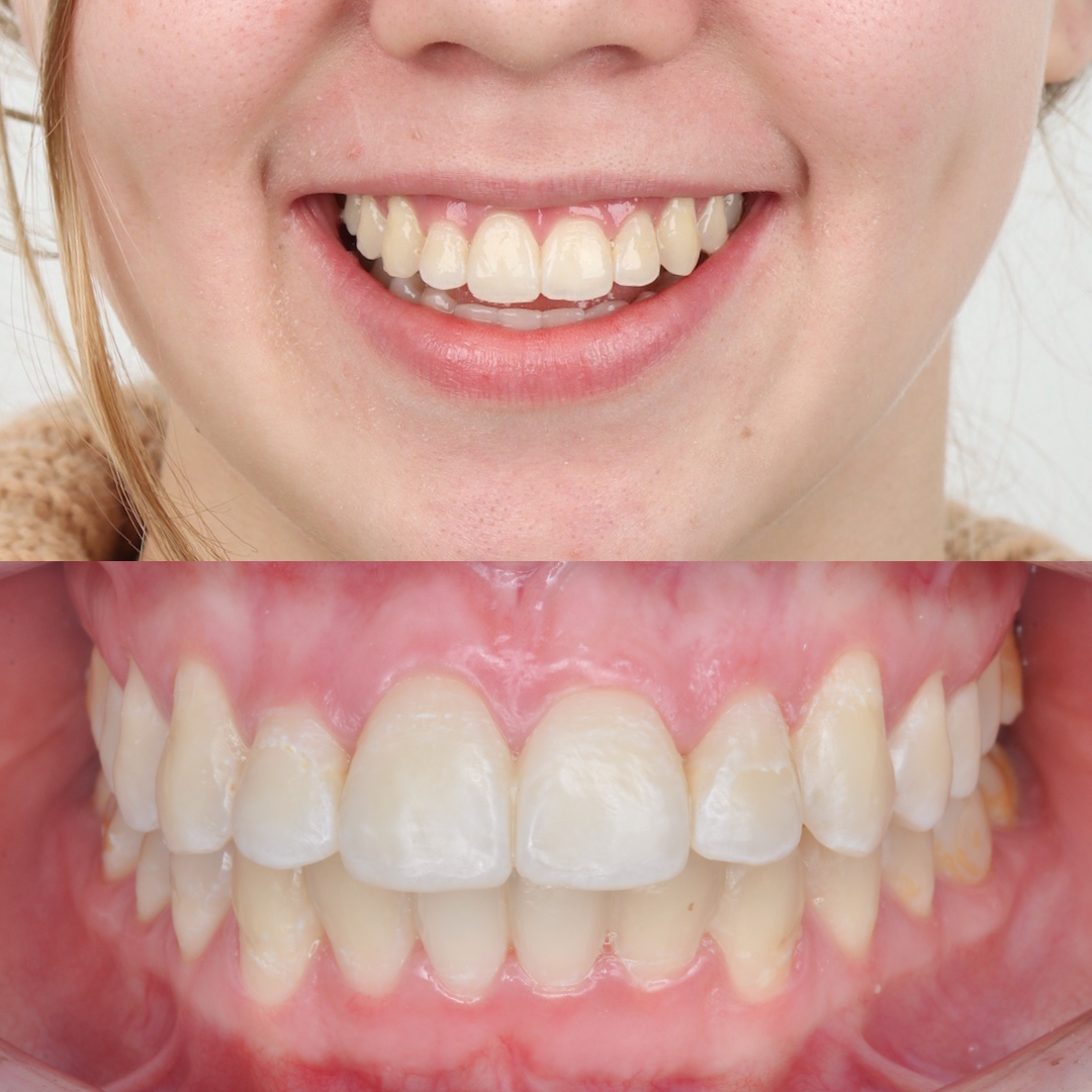 MARPE case result 8