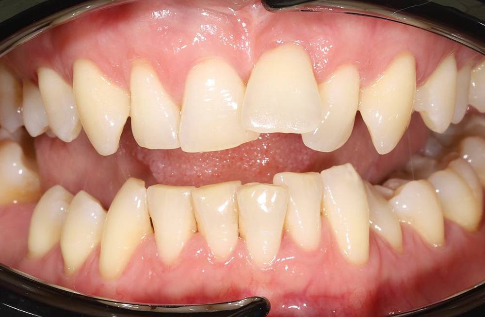 Ортодонтическое лечение с генерализованным пародонтитом