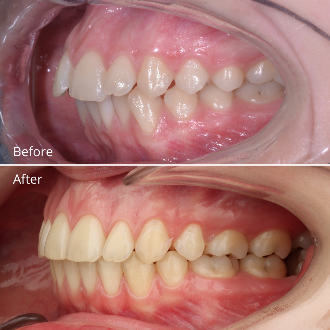 Stage showing continued space closure and bite correction — photo 4 of 7