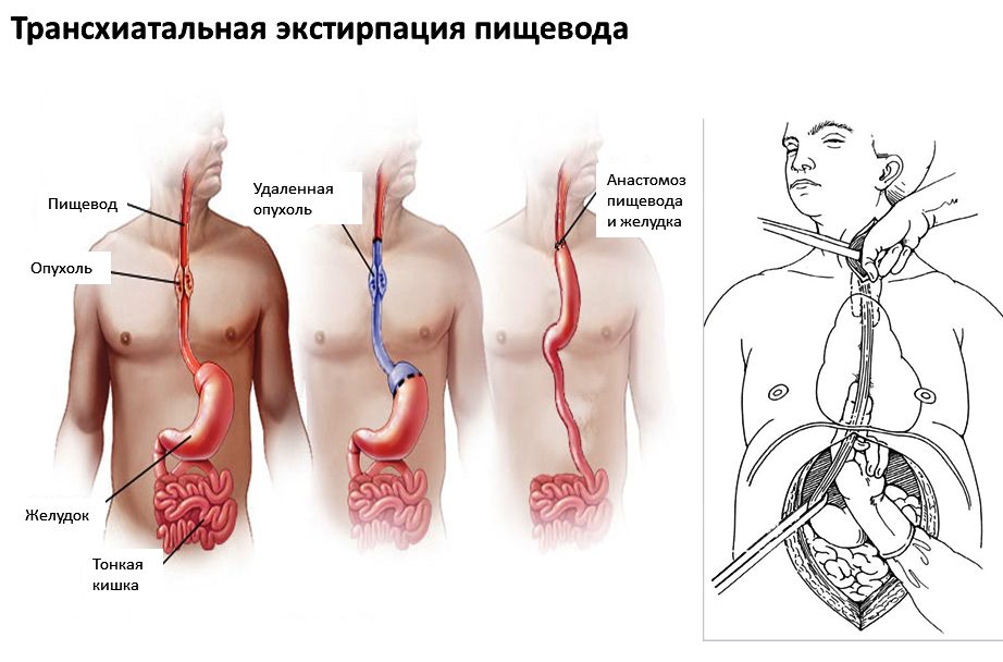 Не-хирургическое лечение против хирургического при раке пищевода (пищевой трубки)