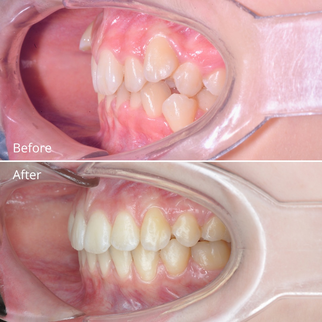 Stage photo showing incisor protrusion assessed before the extraction decision — photo 3 of 4