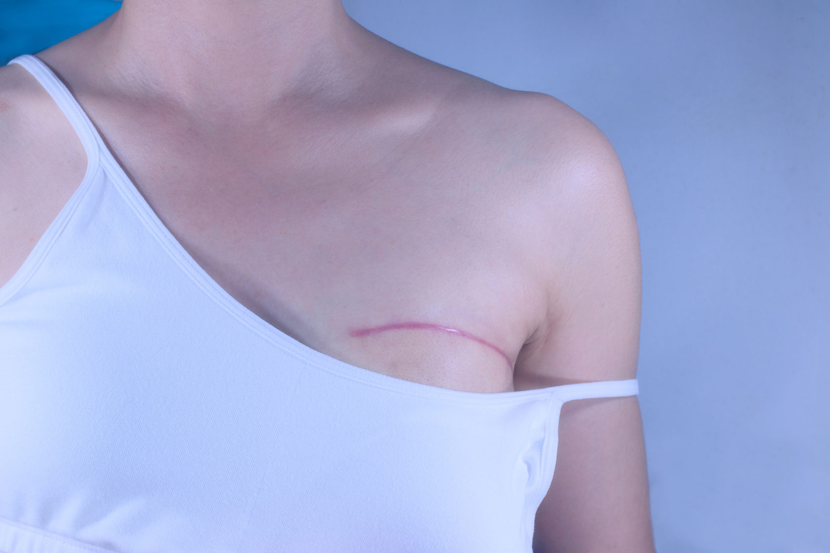 операция по удалению груди у женщин фото 11