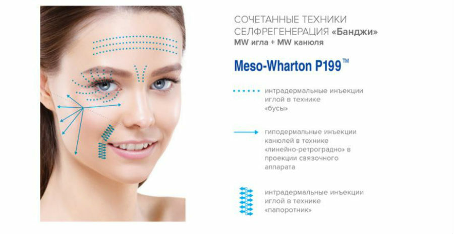 Техника введения препарата Meso Wharton P199