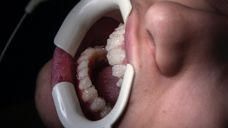 Отбеливание зубов — цены в Дербенте. Стоматологическая клиника DK