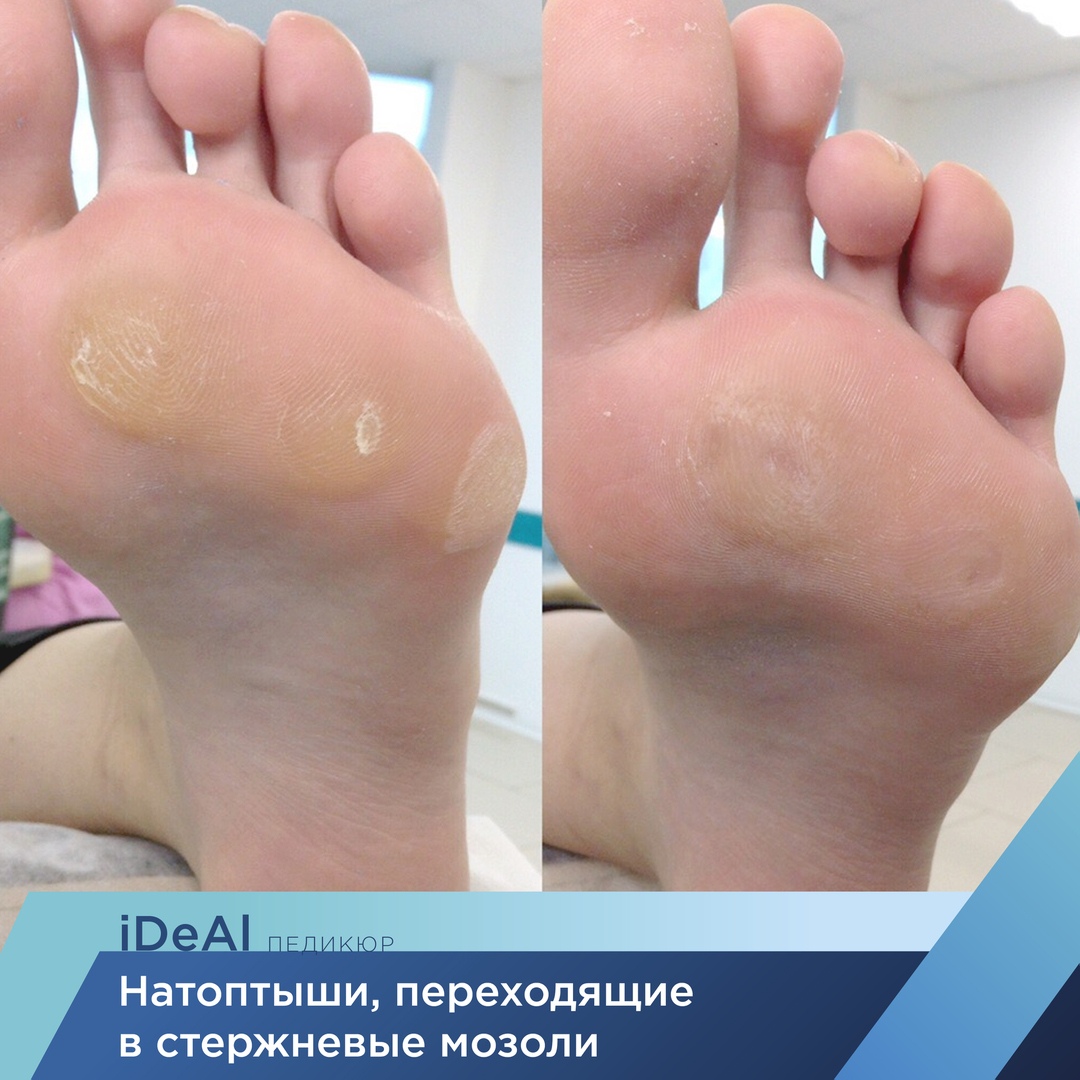 Удаление натоптышей и мозолей в Курске