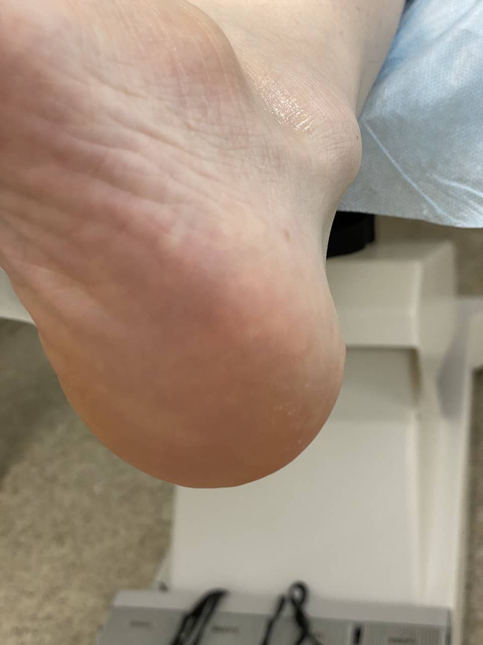 Трещины после глубокие