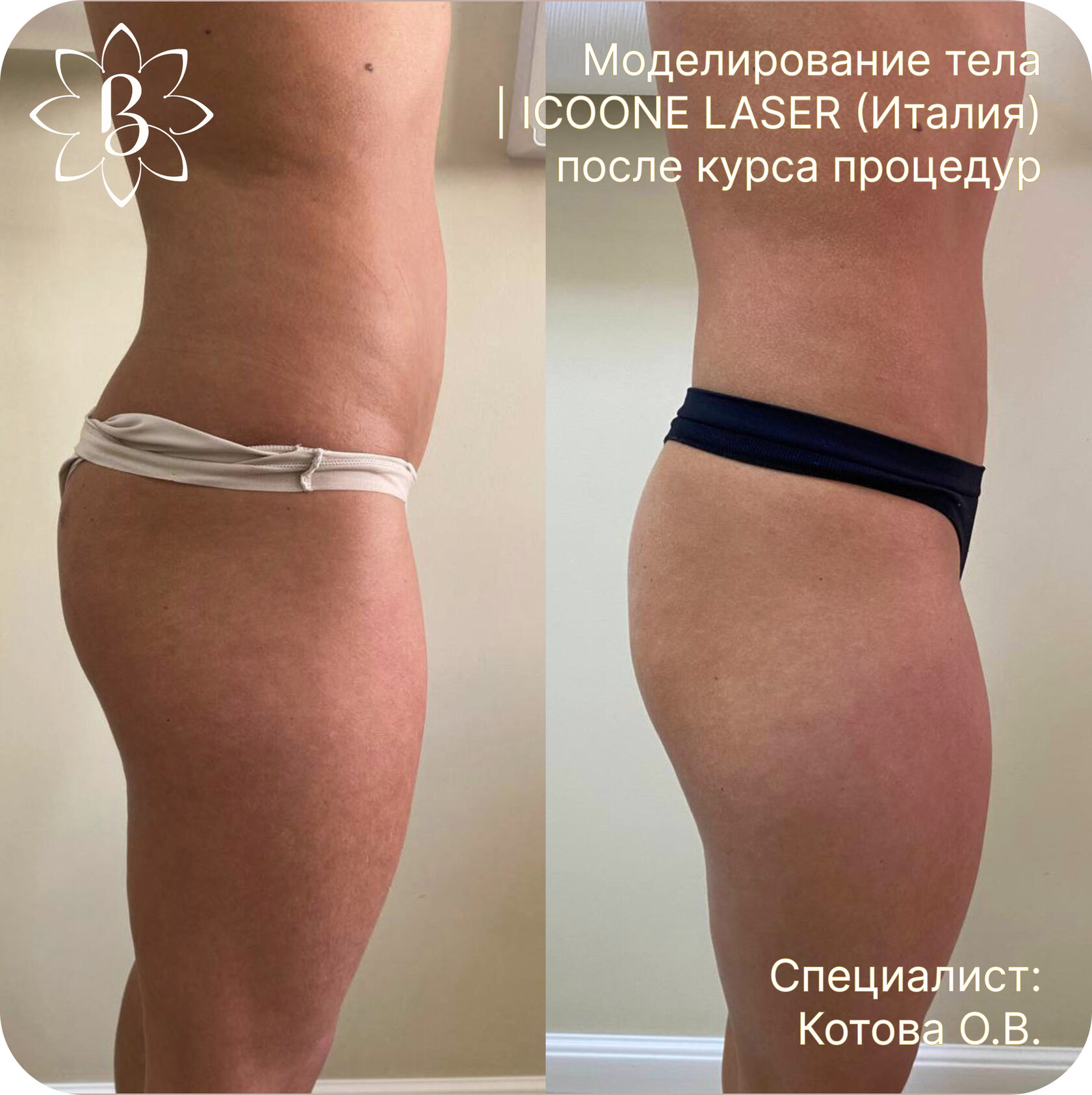 Диодная лазерная эпиляция СПб