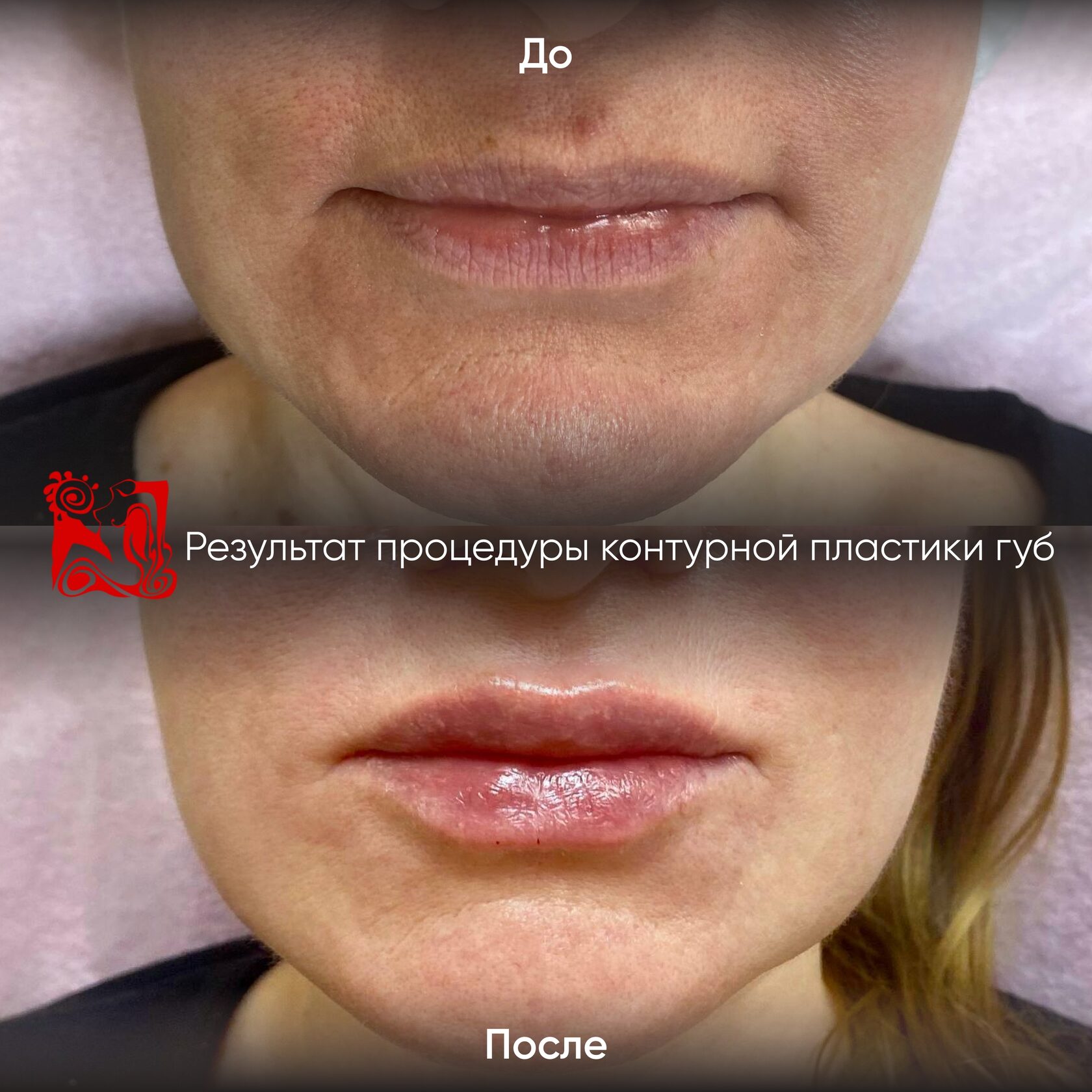 Контурная пластика — фотография 3 из галереи клиники «Эстетика»