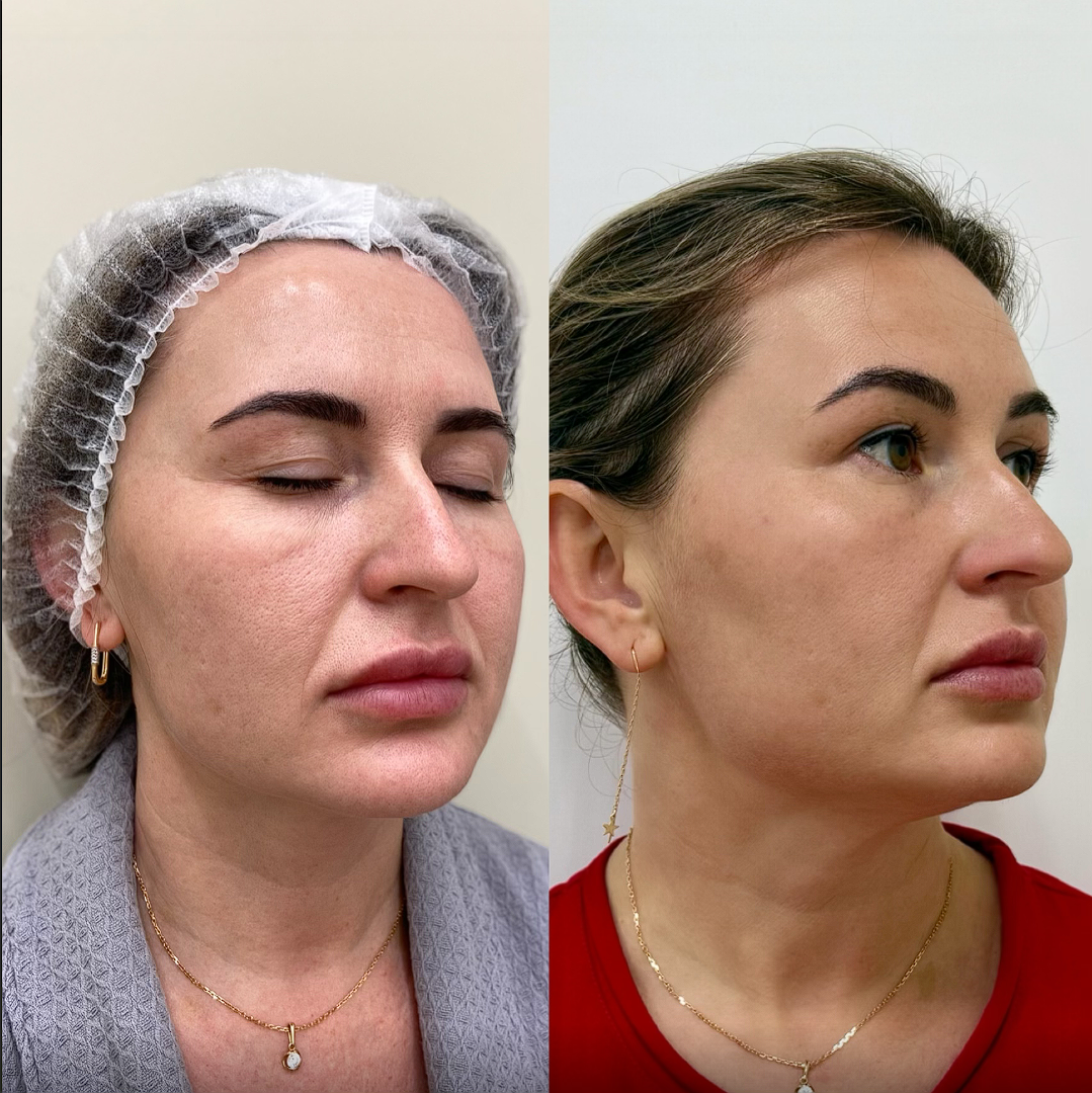 Безоперационная подтяжка лица на Израильском аппарате Morpheus 8