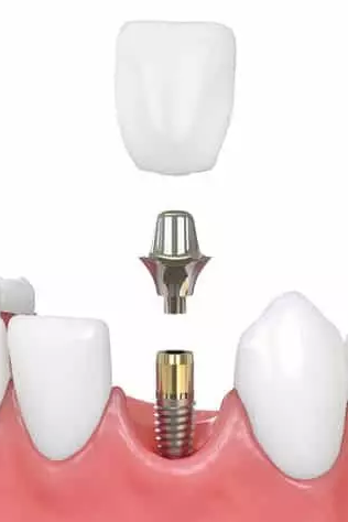 лазерная имплантация зубов. имплант нобель реплейс селект. культирование стоматология. москва лазерная имплантация. москва лазерная имплантация.