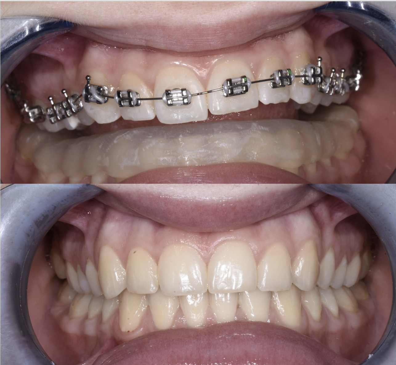 機能咬合のリコンストラクションSlavicek 機能咬合のリ