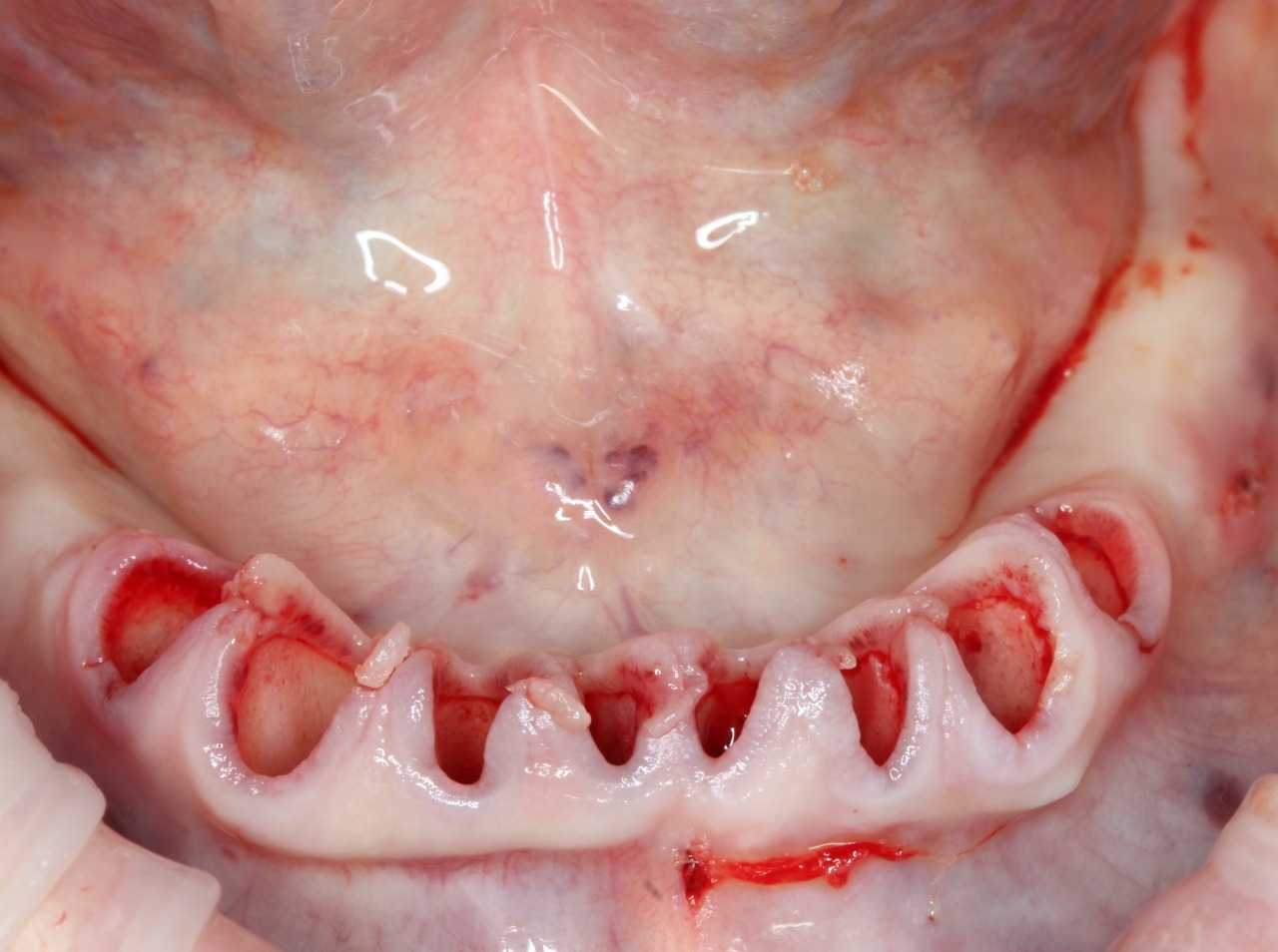 Удаление всех зубов на нижней челюсти