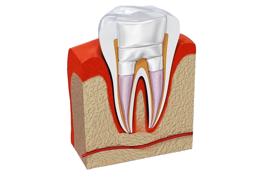Витальная ампутация пульпы. Витальная ампутация пульпита. Девитальная пульпотомия. Периодонтита 3 канального зуба. Пульпит зуба 3 канального зуба.