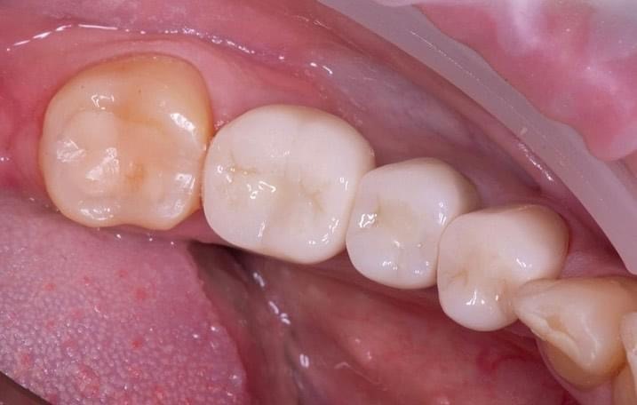 Постоянные реставрации в полости рта пациента