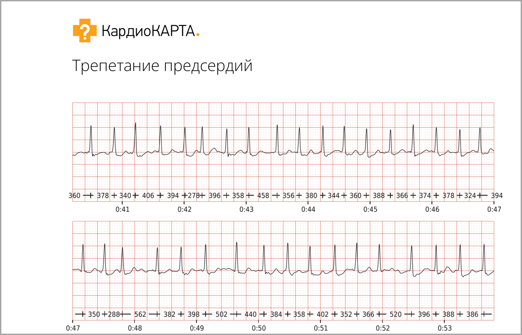 Внезапное сильное сердцебиение: тахикардия, аритмия или не причина для  беспокойства? | КардиоКВАРК