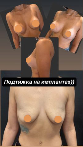 Подтяжка груди с имплантами, результат