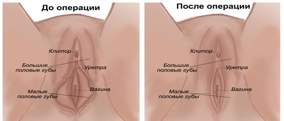 Labioplasty ᐉ Price of labia plastics in Poltava • Reviews of patients from Kiev and Kharkov