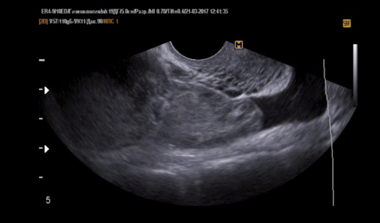 На узи видно внематочную. УЗИ малого таза внематочная беременность. Внематочная беременность на УЗИ. УЗИ органов малого таза внематочной беременности. Внематочная беременность на УЗИ фото.