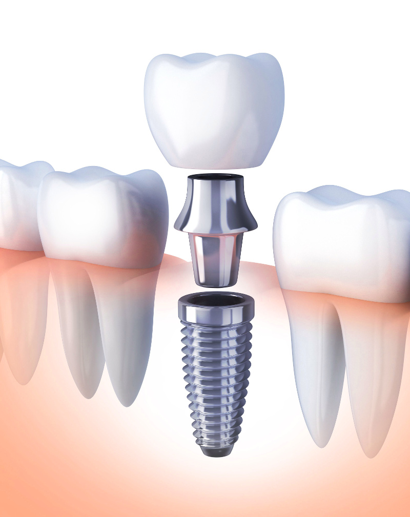 Имплант dentium superline. Зубные имплантаты стелс. Анкилоз импланты. Формирователь десны осстем регуляр. Имплантация люберцы.