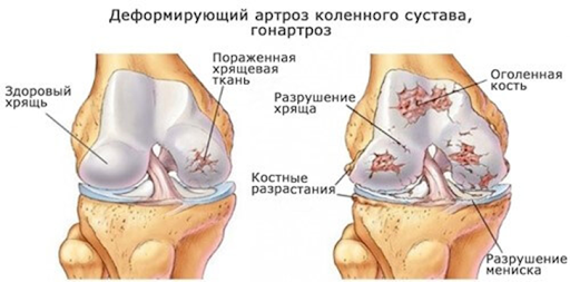 Боль в колене из-за травм