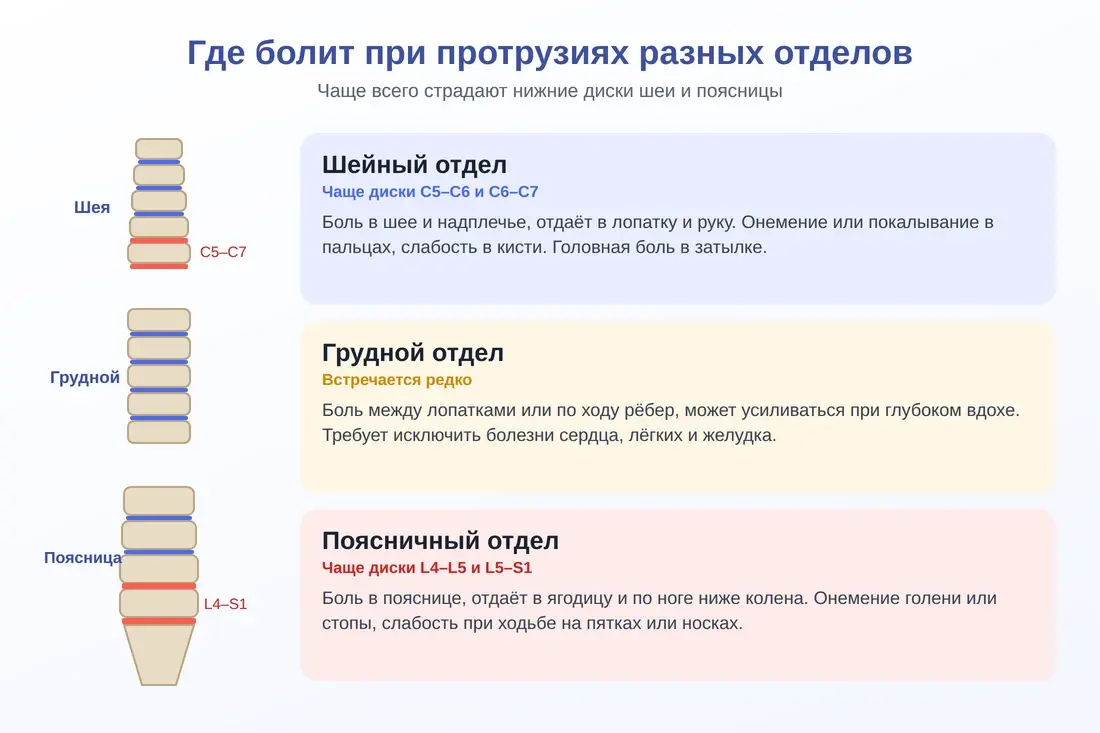 Симптомы протрузий шейного, грудного и поясничного отделов позвоночника