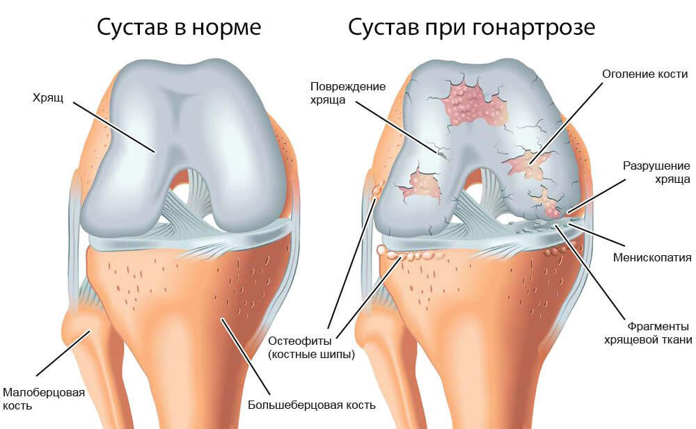 Артроз коленного сустава гонартроз — причины симптомы и методы лечения