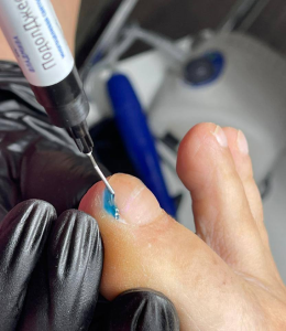 Жидкое тампонирование